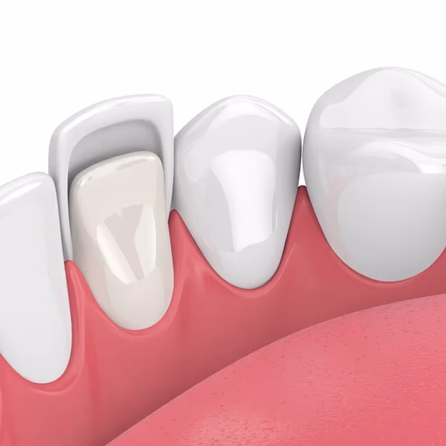 69684683e30ae7c976b61d38_service-thumbnail-veneers