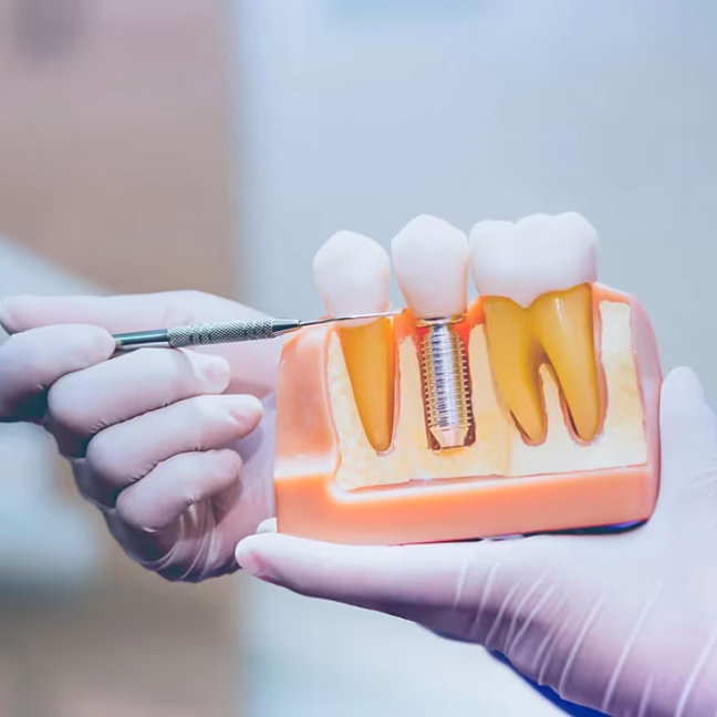 6968468405d8fcbd74cbdd1c_service-thumbnail-dental-implants