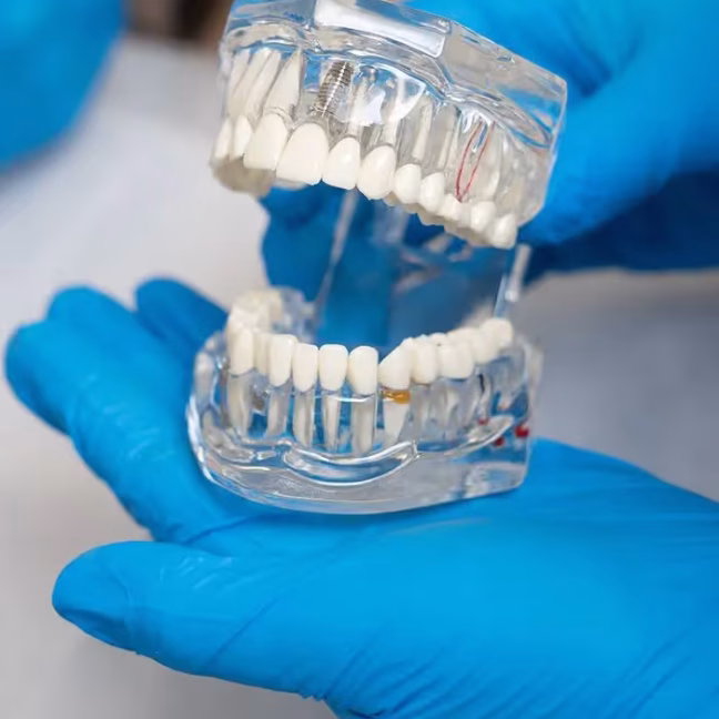 696851e0472382bf0b8615b2_differentiator-dental-implants-recpIjP9efN3pTpAJ