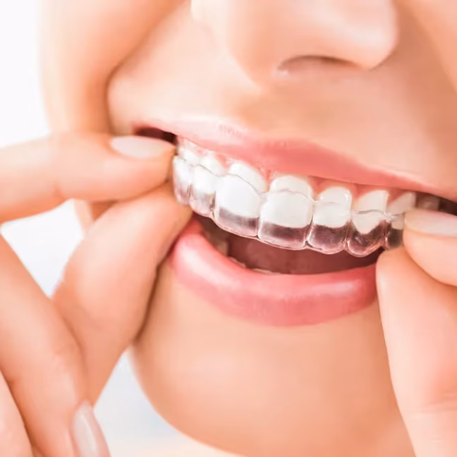696858cf67517ae63d83f706_service-thumbnail-clear-aligners