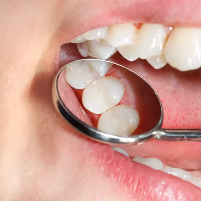 696858d1077db239d4411ad9_service-thumbnail-dental-fillings (1)