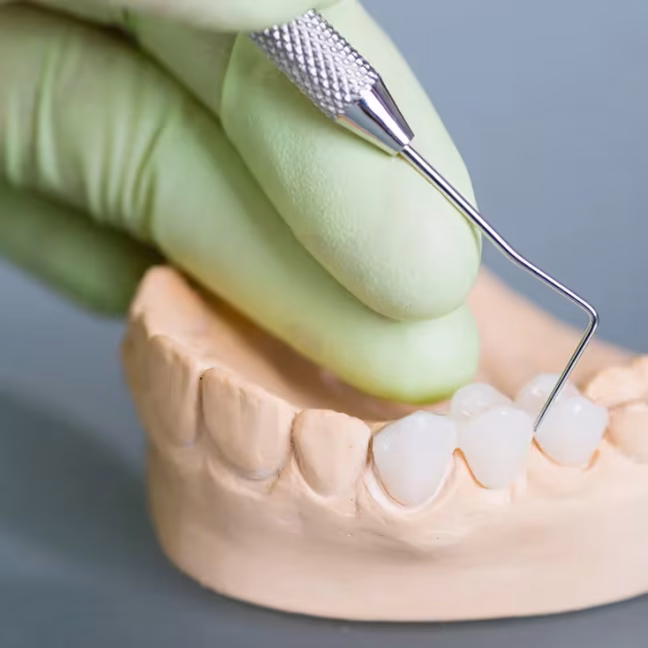 696858d1358ea52a185363c2_service-thumbnail-dental-bridges (1)