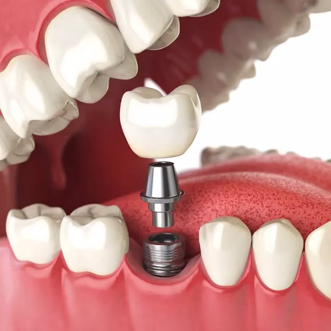 696858d5290bec270d7b2a15_service-thumbnail-implant-crown