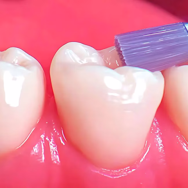 696858daef460bb1fb6796fe_service-thumbnail-dental-sealants