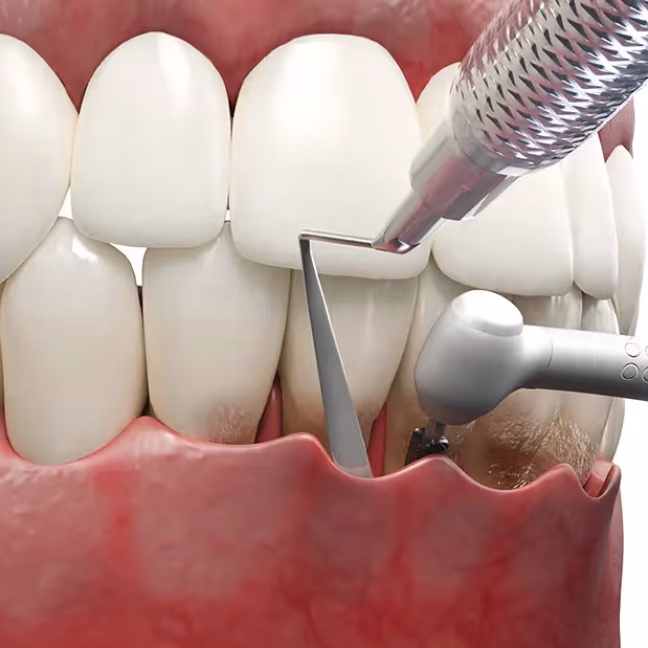 697901669eb1f2285127bbdf_service-thumbnail-pocket-reduction-surgery (1)