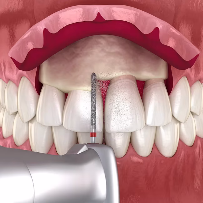 69790166f93093be01988402_service-thumbnail-crown-lengthening (1)