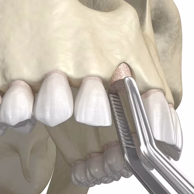 697901674143b42a6f2105db_service-thumbnail-bone-grafting (1)