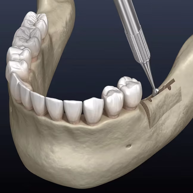 69790167463cc054d41d8ebc_service-thumbnail-ridge-augmentation
